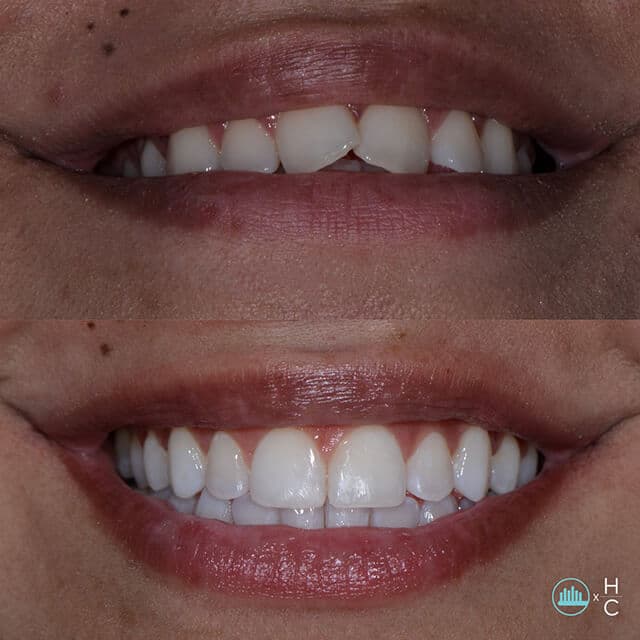 Invisalign-image0